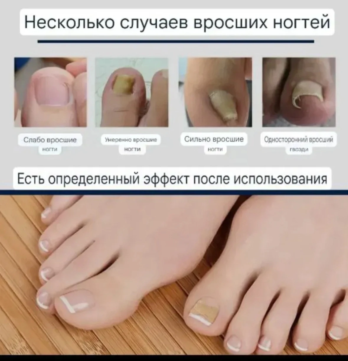 Пластыри для ногтей